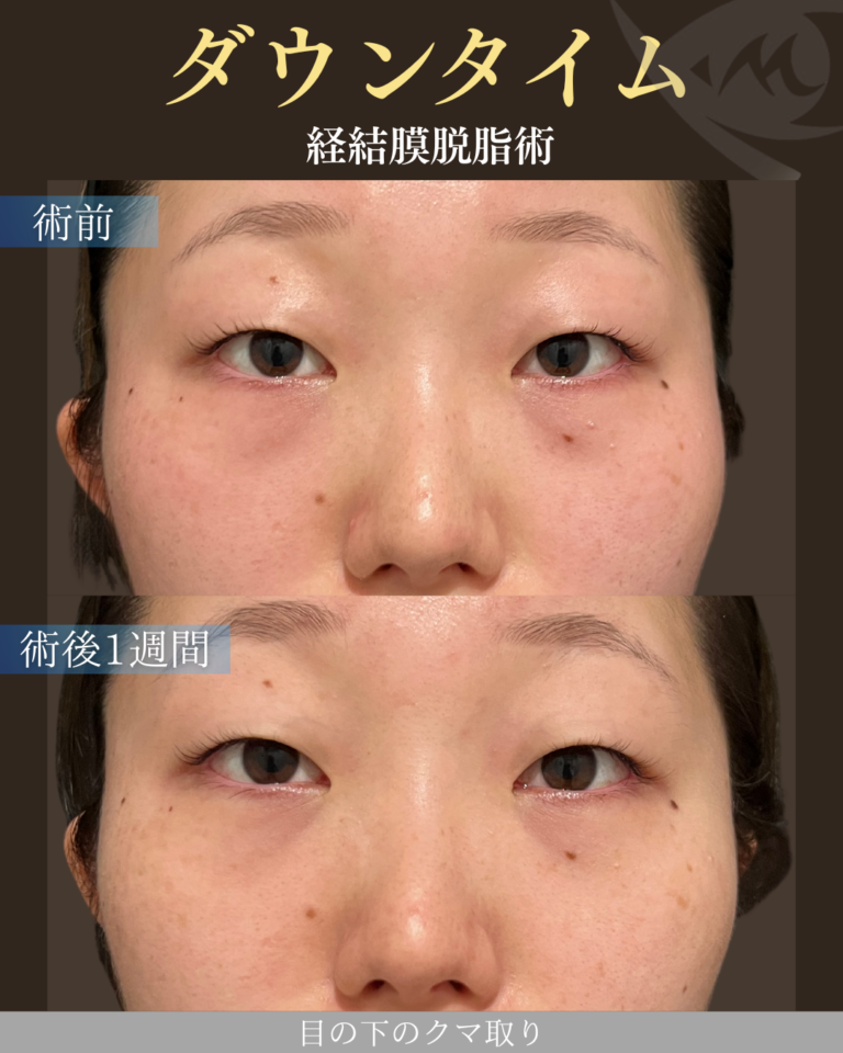 10代女性 経結膜脱脂術 ダウンタイム